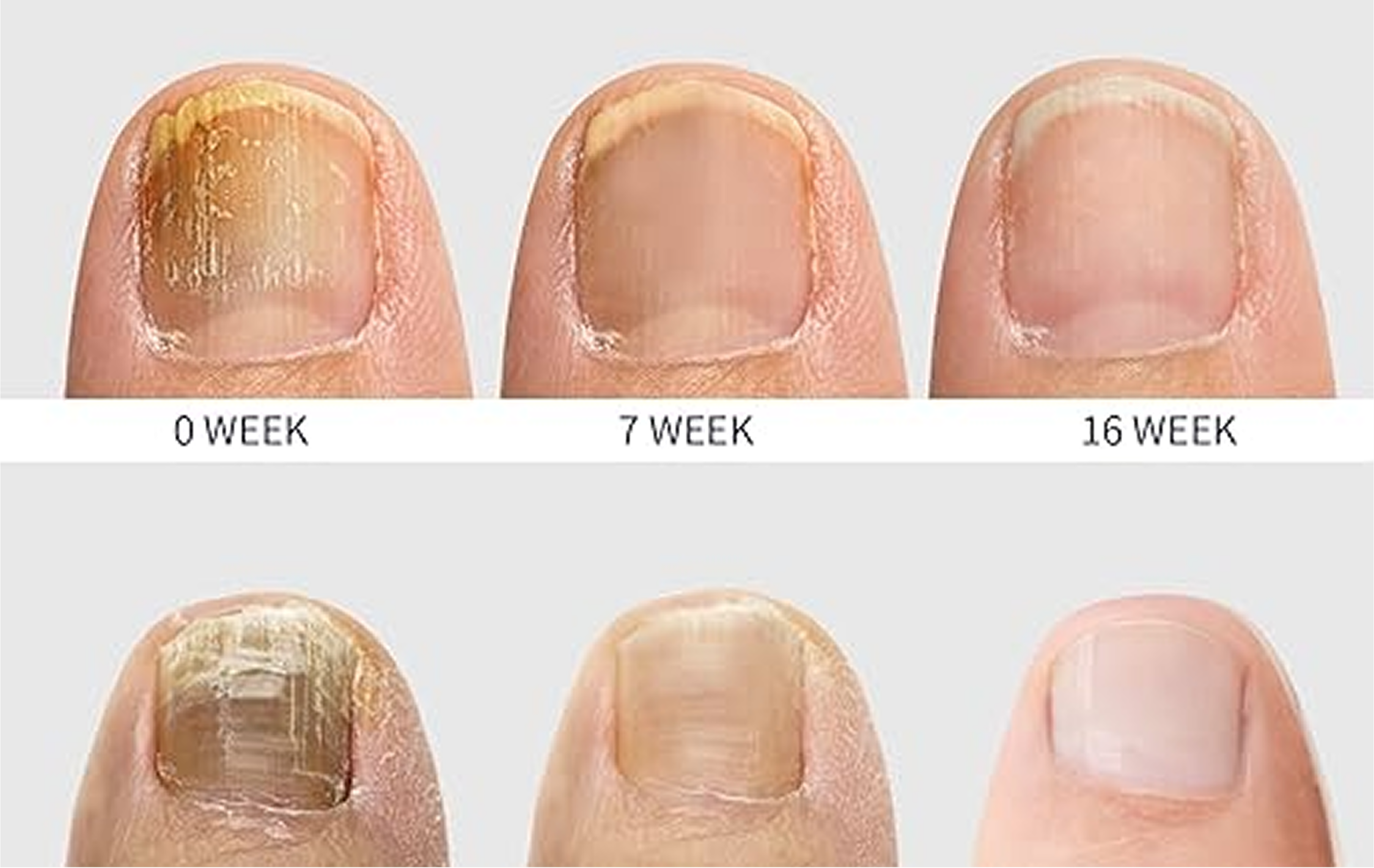 Toe Nail Roots Fungabeam